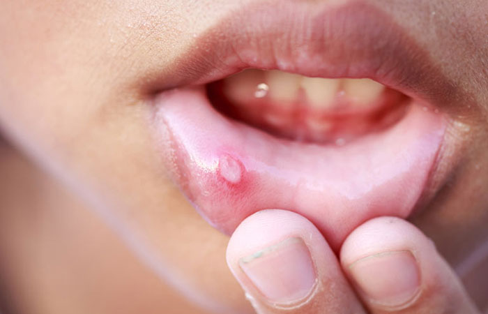 plaies_et_infections_buccales